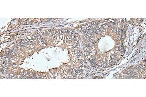 Immunohistochemistry of paraffin-embedded Human colorectal cancer tissue using UNC13B Polyclonal Antibody at dilution of 1:40(x200) (UNC13B anticorps)