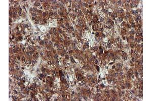 Immunohistochemical staining of paraffin-embedded Carcinoma of Human liver tissue using anti-EPM2AIP1 mouse monoclonal antibody. (EPM2AIP1 anticorps)