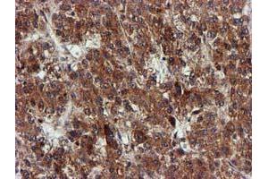 Immunohistochemical staining of paraffin-embedded Carcinoma of Human liver tissue using anti-EPM2AIP1 mouse monoclonal antibody. (EPM2AIP1 anticorps)