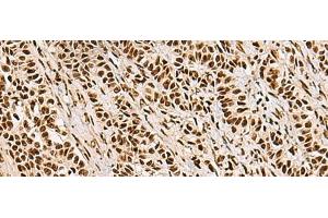 Immunohistochemistry of paraffin-embedded Human ovarian cancer tissue using FOXI1 Polyclonal Antibody at dilution of 1:55(x200) (FOXI1 anticorps)