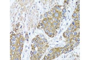 Immunohistochemistry of paraffin-embedded Human prostate cancer using PEX14 Polyclonal Antibody at dilution of 1:100 (40x lens). (PEX14 anticorps)
