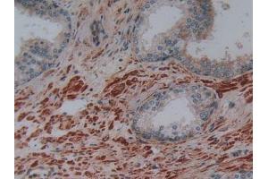 Detection of PLAP in Human Prostate Gland Tissue using Polyclonal Antibody to Phospholipase A2 Activating Protein (PLAP)