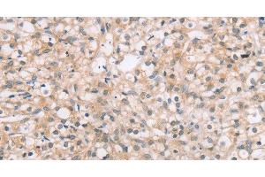 Immunohistochemistry of paraffin-embedded Human prostate cancer tissue using ROR1 Polyclonal Antibody at dilution 1:45