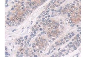 Detection of CRABP2 in Human Prostate cancer Tissue using Polyclonal Antibody to Cellular Retinoic Acid Binding Protein 2 (CRABP2)