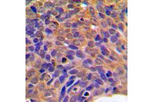Immunohistochemical analysis of Beta-catenin staining in human breast cancer formalin fixed paraffin embedded tissue section.