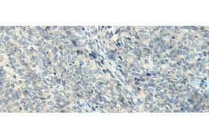 Immunohistochemistry of paraffin-embedded Human ovarian cancer tissue using NPVF Polyclonal Antibody at dilution of 1:80(x200) (NPVF anticorps)