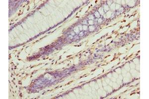 Immunohistochemistry of paraffin-embedded human colon cancer using ABIN7142940 at dilution of 1:100 (ILVBL anticorps  (AA 45-344))
