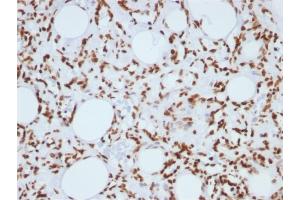 Formalin-fixed, paraffin-embedded human Angiosarcoma stained with Histone H1 Mouse Monoclonal Antibody (1415-1)