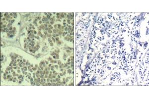 Immunohistochemical analysis of paraffin-embedded human breast carcinoma tissue using eIF2α (phospho-Ser49) Antibody (E011511). (EIF2A anticorps  (pSer49))