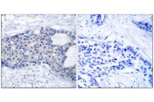 Immunohistochemical analysis of paraffin-embedded human breast carcinoma tissue, using Zap-70 (phospho-Tyr493) antibody (E011160). (ZAP70 anticorps  (pTyr493))