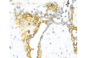 Immunohistochemistry of paraffin-embedded Human breast using CTGF Polyclonal Antibody at dilution of 1:100 (40x lens). (CTGF anticorps)