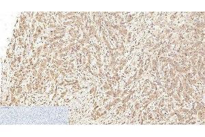 Immunohistochemistry of paraffin-embedded Human breast cancer tissue using Cleaved-CASP1 (D210) Polyclonal Antibody at dilution of 1:200.