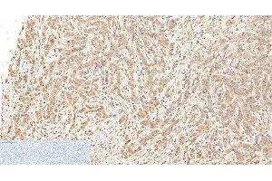 Immunohistochemistry of paraffin-embedded Human breast cancer tissue using Cleaved-CASP1 (D210) Polyclonal Antibody at dilution of 1:200. (Caspase 1 anticorps  (Cleaved-Asp210))