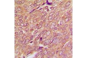 Immunohistochemical analysis of SREBP1 staining in human breast cancer formalin fixed paraffin embedded tissue section. (SREBF1 anticorps)