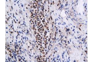 Formalin-fixed and paraffin embedded human cervical intraepithelial xenografts labeled with Anti-Annexin A1 Polyclonal Antibody, Unconjugated (ABIN731378) followed by conjugation to the secondary antibody and DAB staining