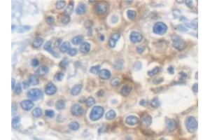 Detection of KRT33A in Human Prostate cancer Tissue using Polyclonal Antibody to Keratin 33A (KRT33A)