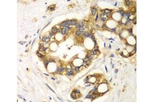 Immunohistochemistry of paraffin-embedded Human liver cancer using RPH3A Polyclonal Antibody at dilution of 1:100 (40x lens). (RPH3A anticorps)