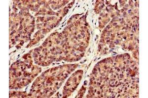 Immunohistochemistry of paraffin-embedded human ovarian cancer using ABIN7166771 at dilution of 1:100 (RBFA anticorps  (AA 201-343))