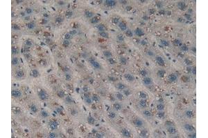 Detection of DDR1 in Human Liver cancer Tissue using Polyclonal Antibody to Discoidin Domain Receptor Family, Member 1 (DDR1)