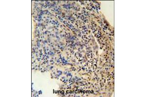 ZNF197 antibody immunohistochemistry analysis in formalin fixed and paraffin embedded human lung carcinoma followed by peroxidase conjugation of the secondary antibody and DAB staining. (ZNF197 anticorps  (N-Term))