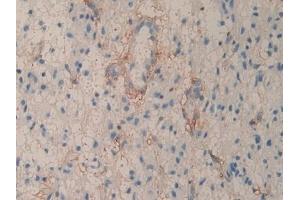 Detection of CD90 in Human Glioma Tissue using Polyclonal Antibody to Cluster of Differentiation 90 (CD90)