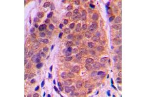 Immunohistochemical analysis of Histone Deacetylase 5 staining in human breast cancer formalin fixed paraffin embedded tissue section.