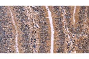 Immunohistochemistry of paraffin-embedded Human colon cancer using CLUAP1 Polyclonal Antibody at dilution of 1:50