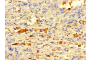Immunohistochemistry of paraffin-embedded human melanoma using ABIN7156574 at dilution of 1:100 (IFI27L2 anticorps  (AA 87-130))