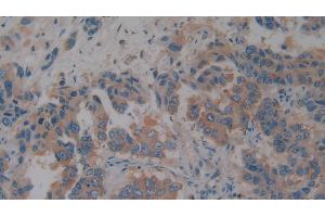 Detection of aZGP1 in Human Breast cancer Tissue using Polyclonal Antibody to Alpha-2-Glycoprotein 1, Zinc Binding (aZGP1)