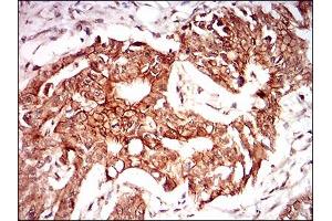 Immunohistochemical analysis of paraffin-embedded rectum cancer tissues using PON1 mouse mAb with DAB staining.