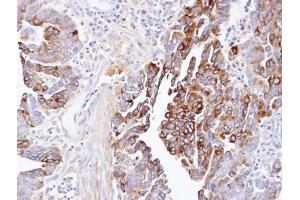 IHC-P Image Immunohistochemical analysis of paraffin-embedded human ovarian cancer, using dynactin 1, antibody at 1:100 dilution.