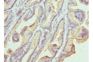 Immunohistochemistry of paraffin-embedded human prostate cancer using ABIN7157198 at dilution of 1:100 (Kallikrein 1 anticorps  (AA 35-276))
