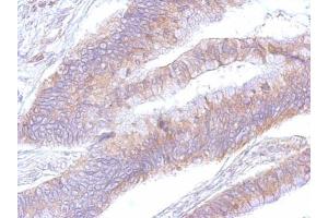 IHC-P Image eEF2 antibody detects eEF2 protein at cytosol on human colon by immunohistochemical analysis.