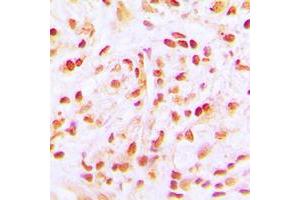 Immunohistochemical analysis of CDC16 staining in human lung cancer formalin fixed paraffin embedded tissue section.