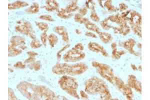 Formalin-fixed, paraffin-embedded human Prostate Carcinoma stained with AMACR / p504S Mouse Monoclonal Antibody (AMACR/1723).