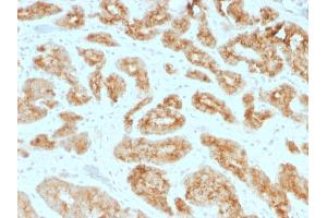 Formalin-fixed, paraffin-embedded human Prostate Carcinoma stained with AMACR / p504S Mouse Monoclonal Antibody (AMACR/1723). (AMACR anticorps)
