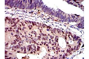 Immunohistochemical analysis of paraffin-embedded colon cancer tissues using MCM2 mouse mAb with DAB staining.