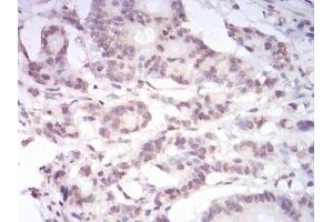 Immunohistochemical analysis of paraffin-embedded colon cancer tissues using PAX6 mouse mAb with DAB staining.