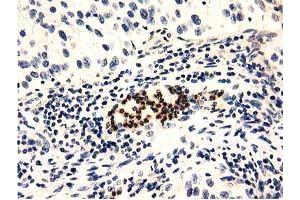Immunohistochemical staining of paraffin-embedded Carcinoma of Human bladder tissue using anti-GAS7 mouse monoclonal antibody. (GAS7 anticorps)