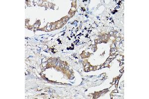 Immunohistochemistry of paraffin-embedded human lung cancer using OL Rabbit pAb (1671) at dilution of 1:100 (40x lens). (OLA1 anticorps  (AA 297-396))