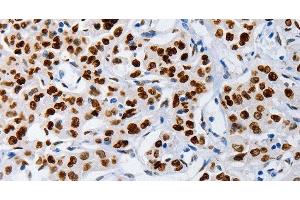 Immunohistochemistry of paraffin-embedded Human lung cancer using MUTYH Polyclonal Antibody at dilution of 1:60 (MUTYH anticorps)