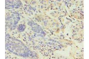 Immunohistochemistry of paraffin-embedded human gastric cancer using ABIN7158812 at dilution of 1:100