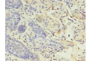 Immunohistochemistry of paraffin-embedded human gastric cancer using ABIN7158812 at dilution of 1:100 (LYZ anticorps  (AA 19-148))