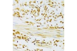 Immunohistochemistry of paraffin-embedded human gastric cancer using HMGB1 Antibody. (HMGB1 anticorps  (AA 100-200))