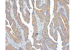 IHC analysis of IQGAP1 using anti-IQGAP1 antibody (ABIN6719262). (IQGAP1 anticorps)