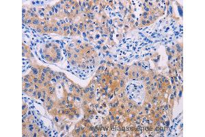 Immunohistochemistry of Human lung cancer using AGT Polyclonal Antibody at dilution of 1:30 (AGT anticorps)