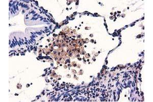 Immunohistochemical staining of paraffin-embedded Carcinoma of Human lung tissue using anti-GAS7 mouse monoclonal antibody. (GAS7 anticorps)