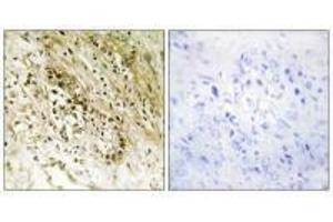 Immunohistochemistry analysis of paraffin-embedded human prostate carcinoma tissue, using PDZD2 antibody. (PDZD2 anticorps)