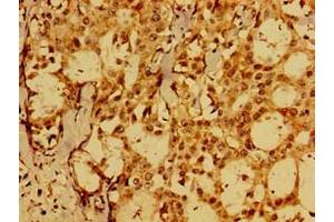 Immunohistochemistry of paraffin-embedded human breast cancer using ABIN7152575 at dilution of 1:100