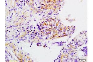 Formalin-fixed and paraffin embedded human laryngeal cancer labeled with Anti-APOH Polyclonal Antibody, Unconjugated  at 1:200 followed by conjugation to the secondary antibody and DAB staining.